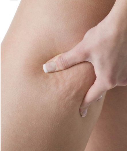 What Food Can Help Reduce Cellulite Fooducate
